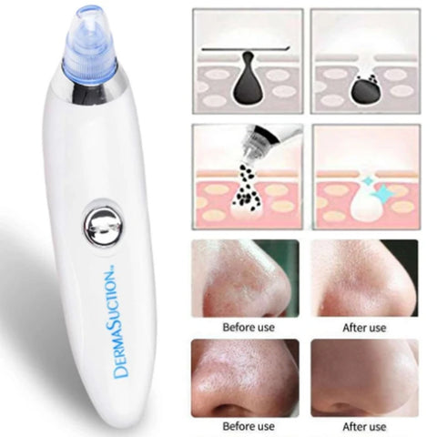 4 in 1 Derma Vacuum Suction Blackhead/Acne/Pore Cleaner 🌞💁♀️