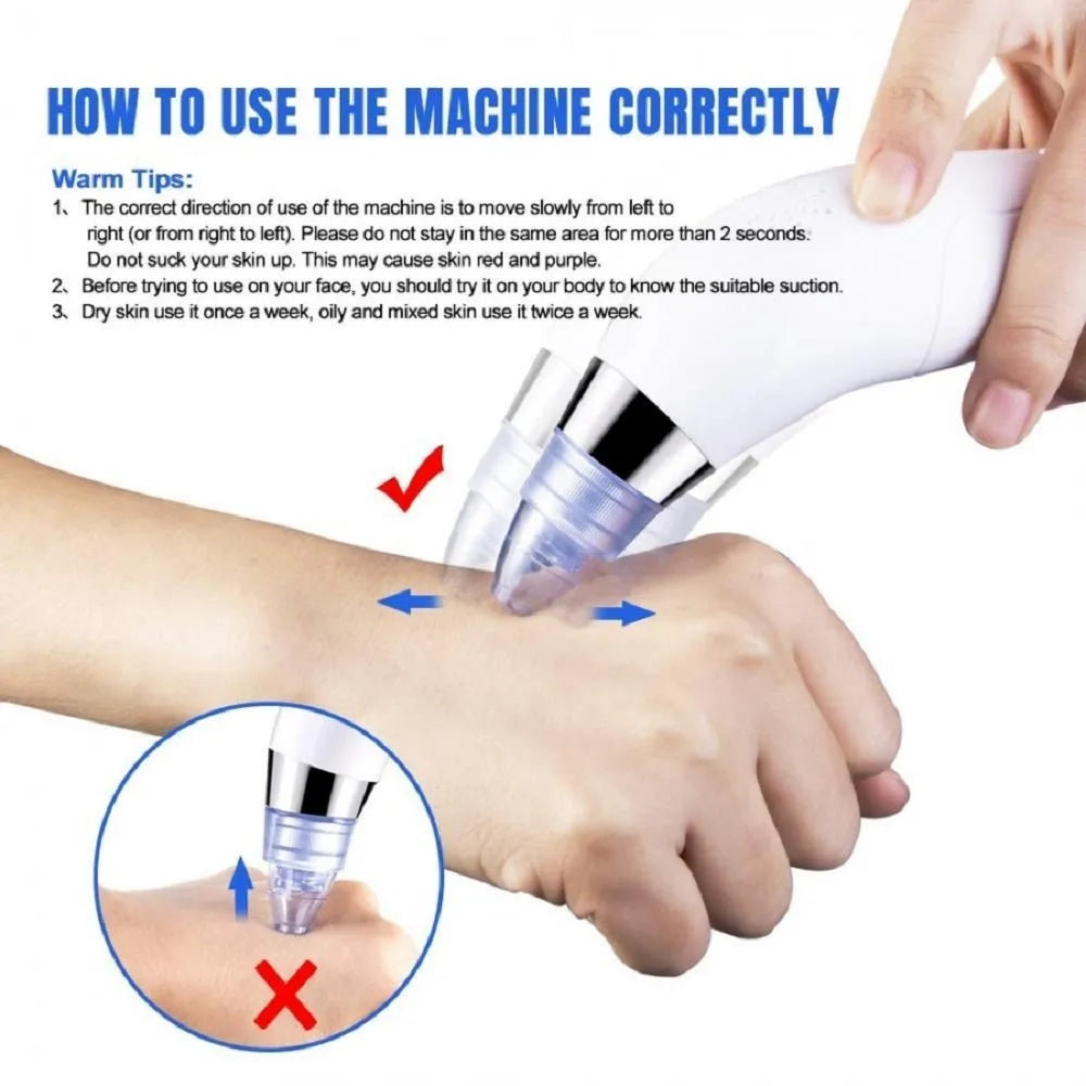 4 in 1 Derma Vacuum Suction Blackhead/Acne/Pore Cleaner 🌞💁♀️