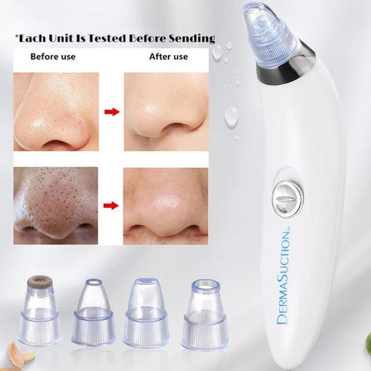 4 in 1 Derma Vacuum Suction Blackhead/Acne/Pore Cleaner 🌞💁‍♀️